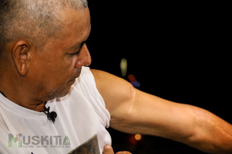 El defensor de la tierra, Tomás Manzanares, muestra las cicatrices de los cuatro disparos que recibió tras denunciar la ocupación ilegal de tierras indígenas en Rus Rus, Puerto Lempira.